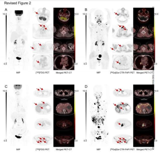 Chinese researchers make breakthrough in precision management for thyroid cancer