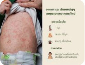 Lao Friends Hospital Confirms Measles Cases, Warns of Possible Outbreak in Luang Prabang